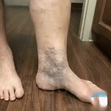 Plasturele Magic — Scapă de Varice în 7 Zile!